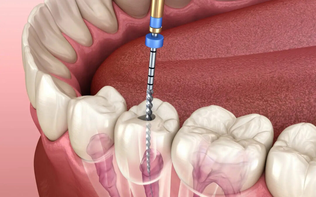 Root Canal Therapy: Restoring Comfort and Preserving Smiles