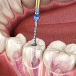 root canal treatment